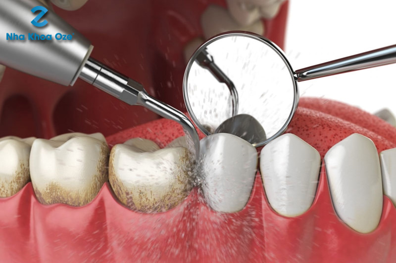 Lấy cao răng định kỳ giúp bảo vệ răng miệng