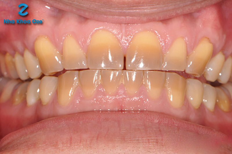 Răng bị nhiễm Tetracycline