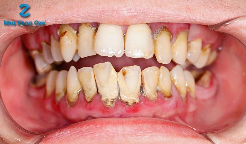 Cao răng dẫn tới tình trạng viêm nướu, ăn mòn chân răng