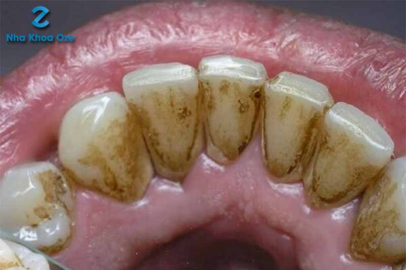 Cao răng nước bọt: Nguyên nhân và cách điều trị