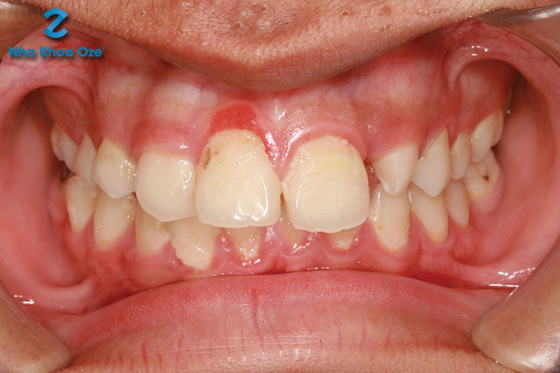 Cao răng gây viêm lợi, khiến lợi sưng đỏ