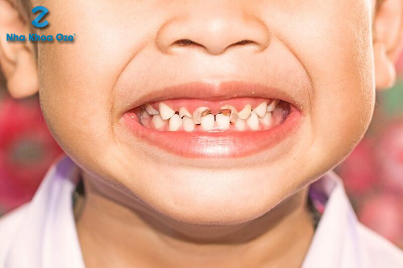 Cao răng phá hủy men răng ở trẻ