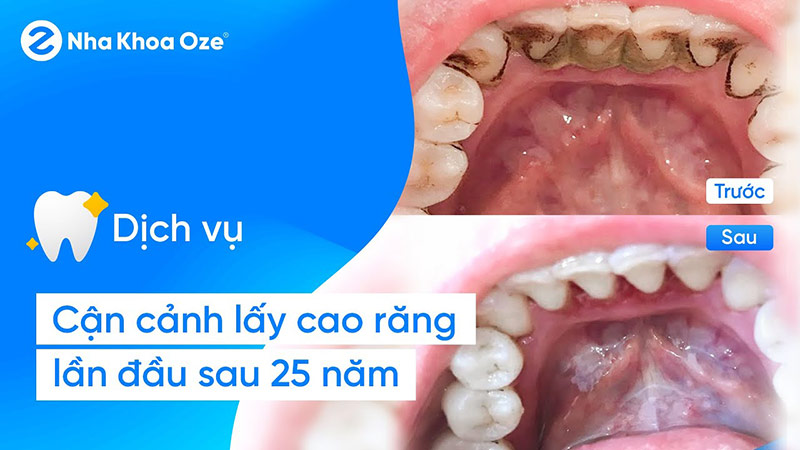 Lấy cao răng giúp răng sạch, sáng, khỏe và ngăn ngừa nhiều bệnh lý răng miệng