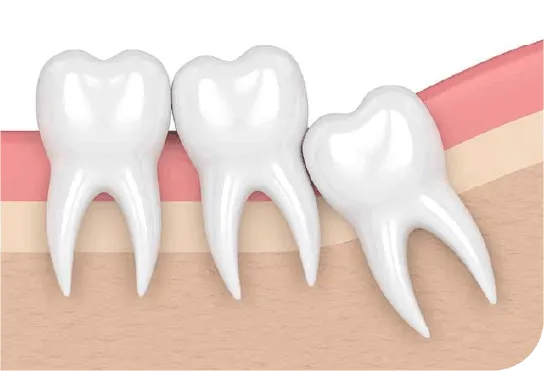 Răng khôn là răng mọc cuối cùng khi trưởng thành