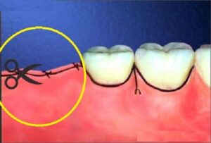 Có cần khâu lợi sau khi nhổ răng khôn không?