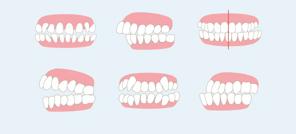 Khớp cắn chuẩn là gì? 6 điều về khớp cắn chuẩn bạn nên biết