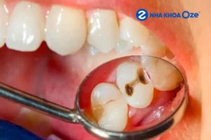 Lấy tủy răng có đau không? 5 điều về lấy tủy răng bạn nên biết