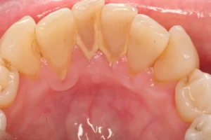 Cao răng đẩy tụt lợi xuống làm lộ rõ chân răng