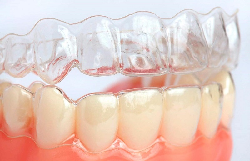 Niềng răng không mắc cài là gì? Phương pháp niềng răng thẩm mỹ nhất hiện nay