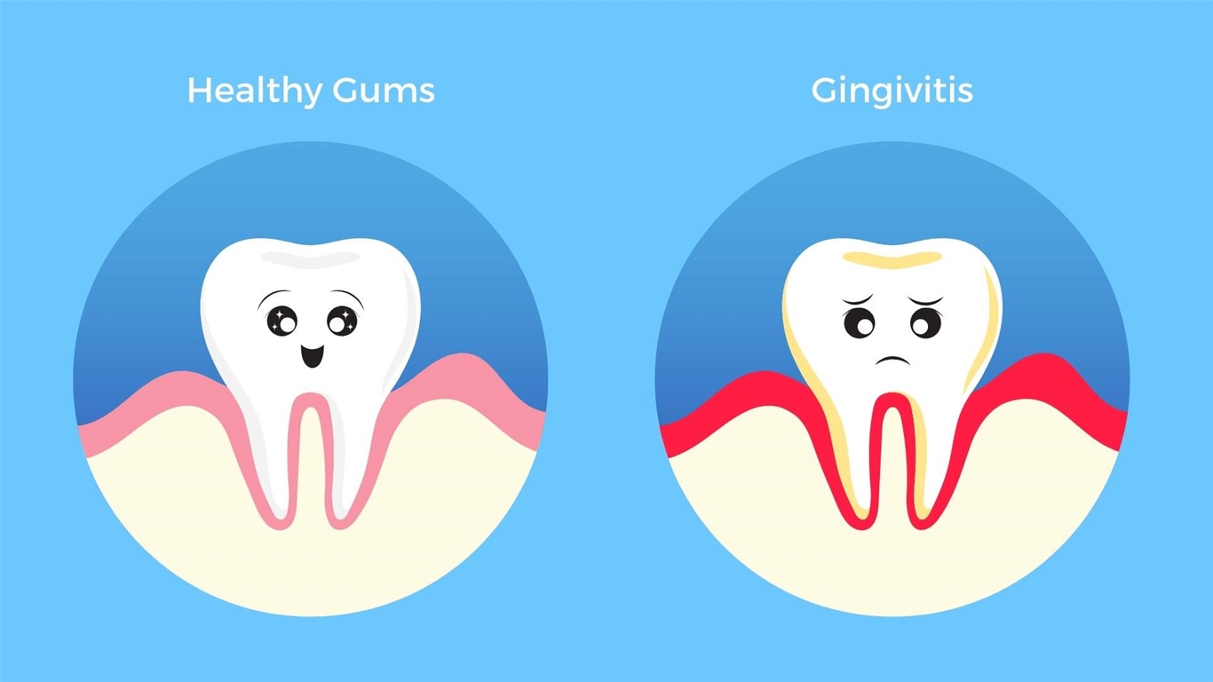 Cách giải quyết hiện tượng chảy máu chân răng