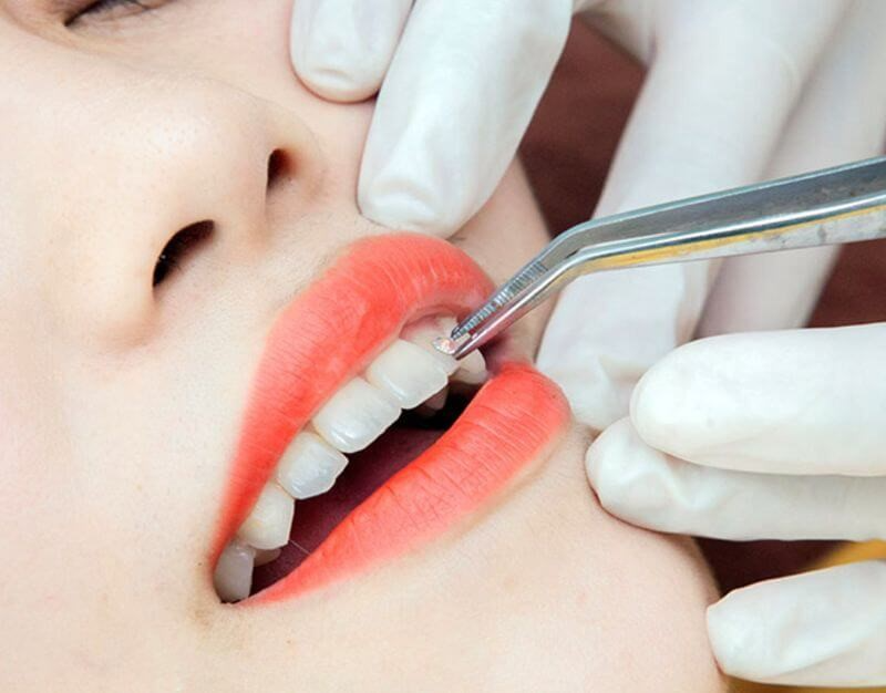 Đính đá vào răng có hại không phụ thuộc rất lớn vào kỹ thuật thực hiện việc đính đá và tay nghề của bác sĩ trực tiếp thực hiện