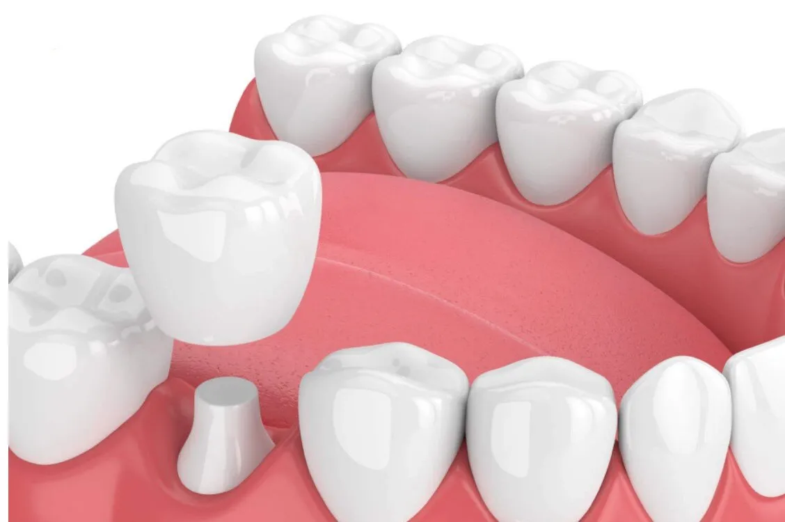 Ảnh minh họa phục hình răng bằng phương pháp bọc răng sứ
