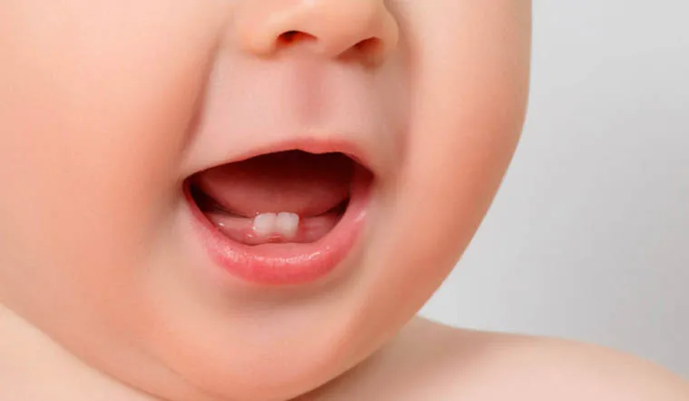 Giai đoạn mọc răng sữa của bé thông thường rơi vào khoảng 6 tháng – 1 năm tuổi.