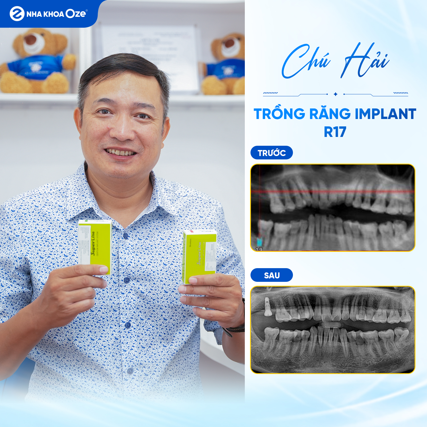 Lựa chọn trụ implant cần phụ thuộc vào tình trạng răng của bạn
