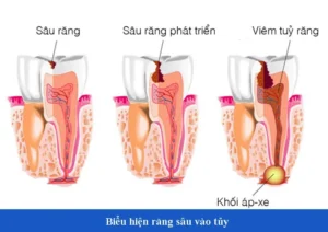 Những dấu hiệu nhận biết răng sâu vào tuỷ