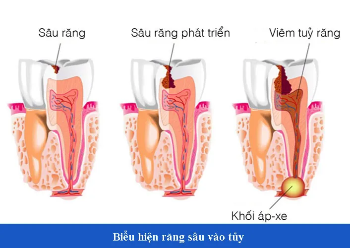 Những dấu hiệu nhận biết răng sâu vào tuỷ