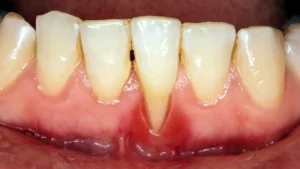 Ngoài gây tụt lợi, cao răng còn gây ra một số bệnh lý răng miệng khác