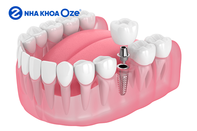 Trồng răng implant trả góp là gì?