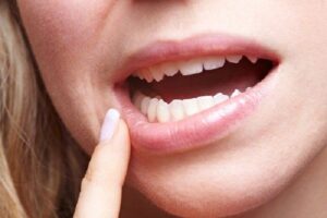 Răng khôn bị lung lay nên xử lý như thế nào? Có nên nhổ không?