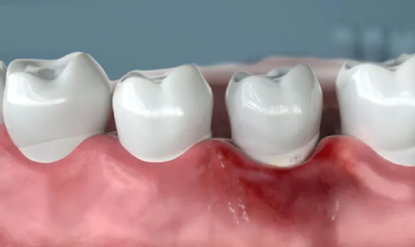 Ảnh minh họa về răng sứ kém chất lượng gây hôi miệng