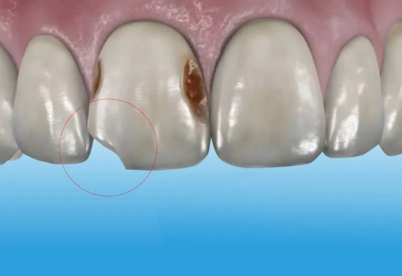 Mảnh vụn mẻ răng rất dễ theo thức ăn trôi xuống các cơ quan tiêu hóa