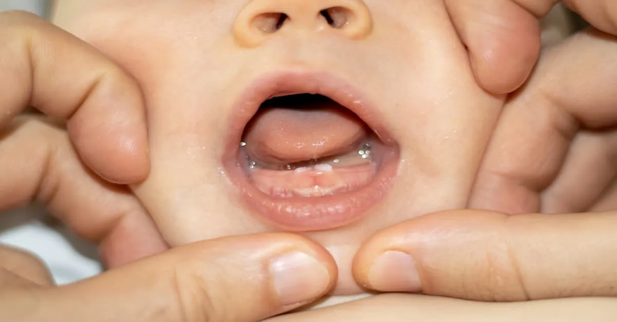 Dấu hiệu mọc răng sữa ở trẻ