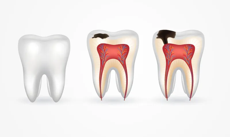 Răng sâu vào tủy rất nguy hiểm