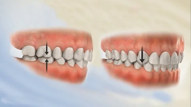 Nên niềng răng implant hay trồng răng trước?