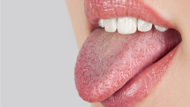 Khô miệng gây nên hôi miệng là tình trạng hay gặp
