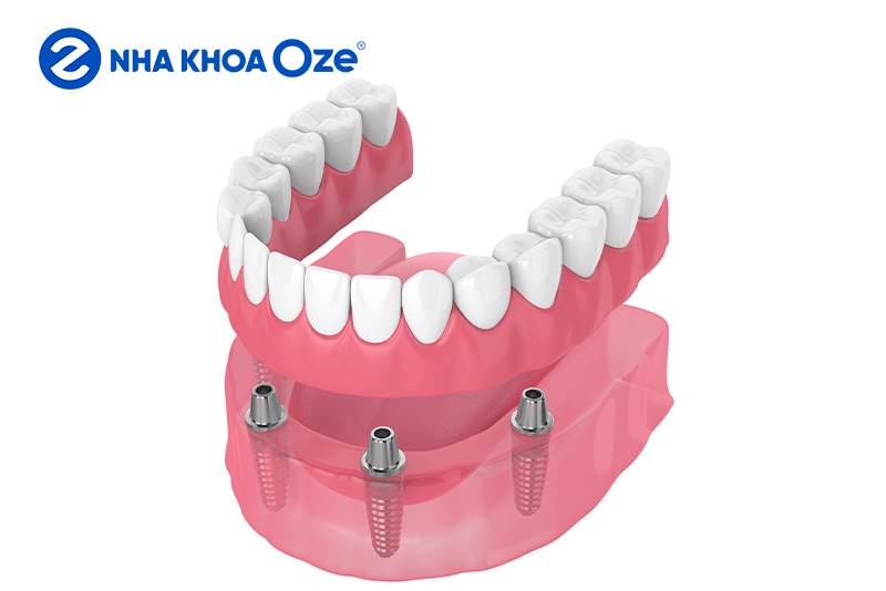 Trồng răng giả cố định là gì