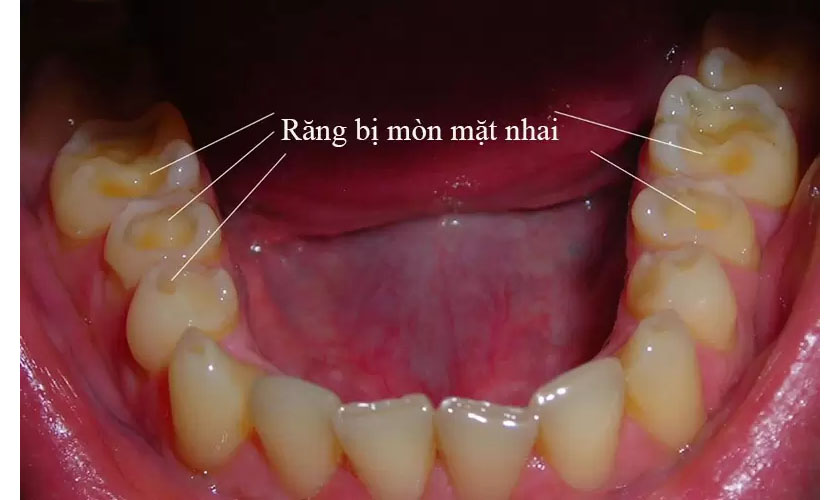 Răng bị mòn mặt nhai phải làm sao?