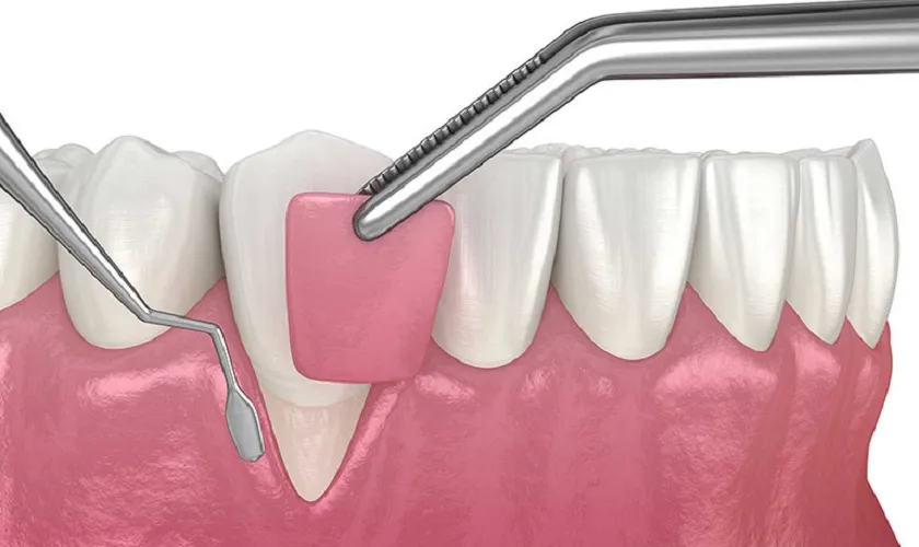 Đối với các trường hợp nặng, cần can thiệp phẫu thuật để khắc phục