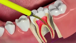 Răng sâu vào tuỷ có nguy hiểm không? Cách điều trị răng sâu vào tuỷ