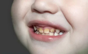 Tình trạng răng bị ố vàng ở trẻ và cách khắc phục