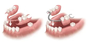 Phục hình ăn nhai với răng giả tháo lắp