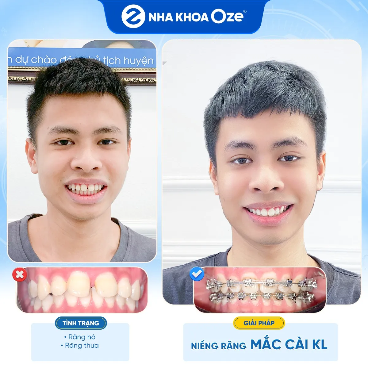 Niềng răng là biện pháp giúp trị liệu răng thưa hiệu quả và lâu dài nhất ở thời điểm hiện tại