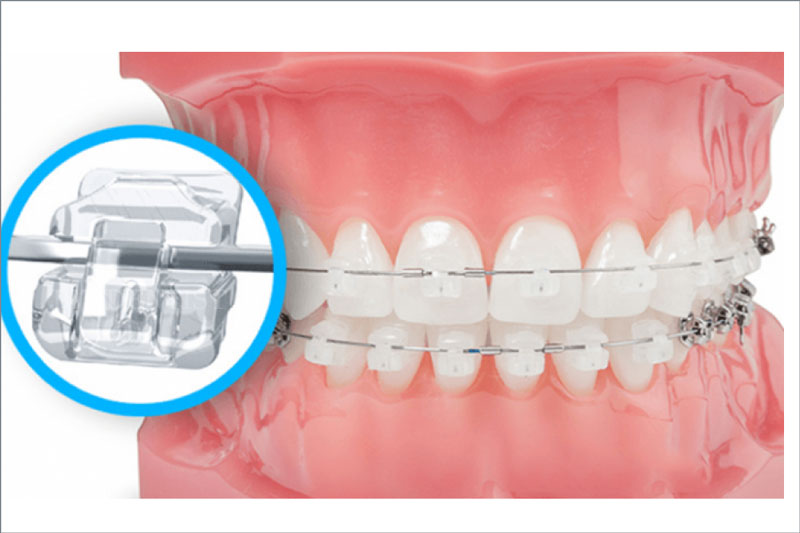 Mắc cài sứ tự đóng giúp cải thiện ê buốt khi niềng