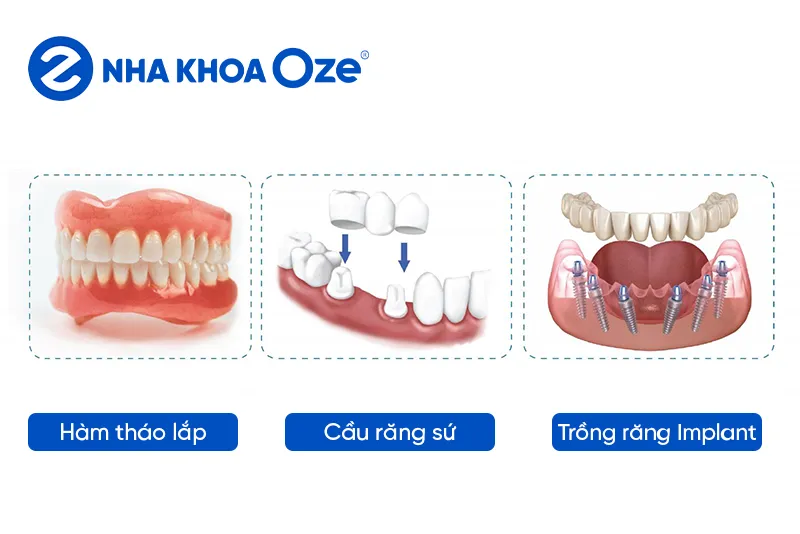 [Tư vấn] 5 lưu ý bạn nên biết khi trồng răng giả