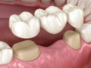 Phục hình răng mất bằng phương pháp cầu răng sứ