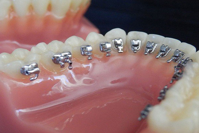 Niềng răng mặt trong được gắn vào mặt bên trong của răng, tăng tính thẩm mỹ và phù hợp với những người phải giao tiếp nhiều