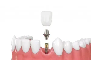 Sử dụng phương pháp cấy ghép
