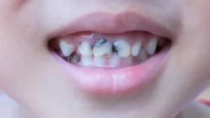 Răng bé bị mảng bám đen do đâu? Cách khắc phục như thế nào?
