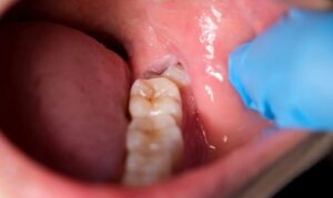 Răng khôn mọc lệch ra má là như thế nào? Cách xử lý an toàn?