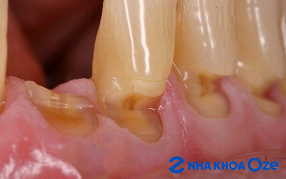 Ảnh minh họa tình trạng mòn cổ răng gây mất răng