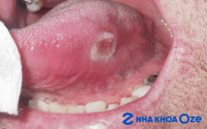 Ảnh minh họa vết loét ung thư miệng