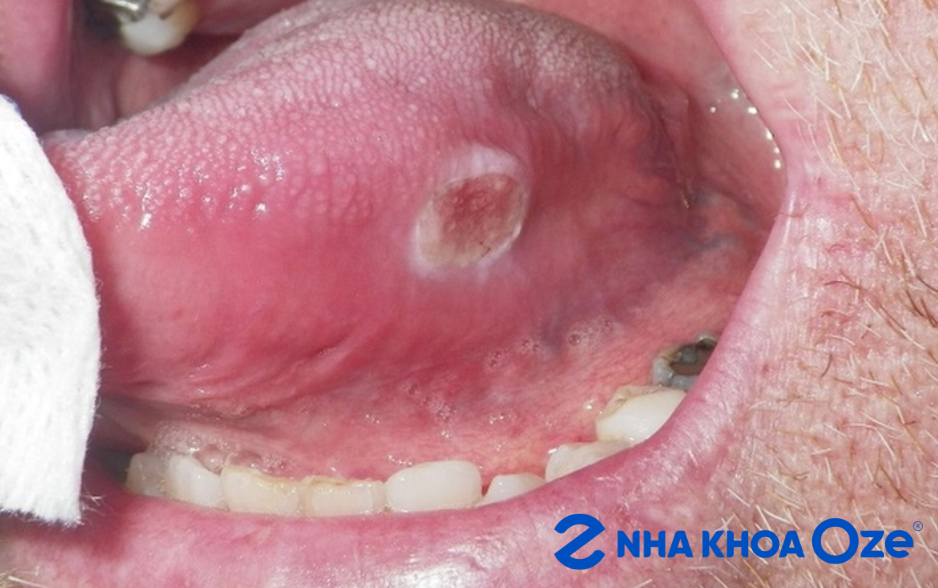 Ảnh minh họa vết loét ung thư miệng