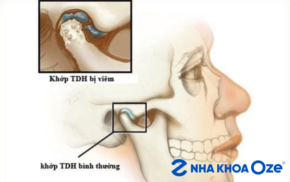 Ảnh minh họa viêm khớp thái dương hàm