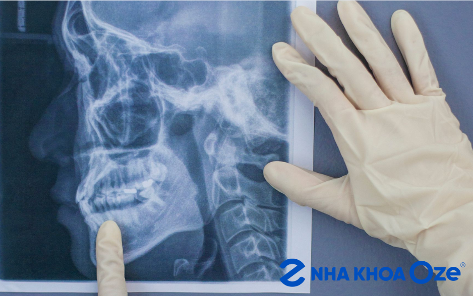 Bệnh nhân được chụp X – quang để xác định tình trạng viêm khớp thái dương hàm trước khi điều trị
