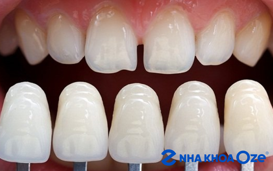 Bọc răng sứ thẩm mỹ để điều chỉnh các khớp cắn bị lệch