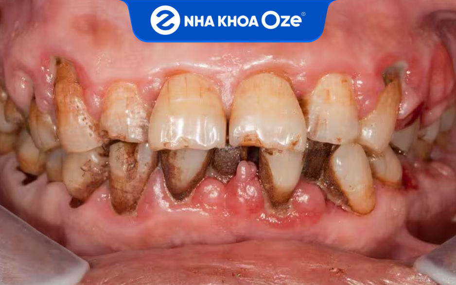 Cao răng đen bám trên răng vô cùng xấu xí và mất thẩm mỹ